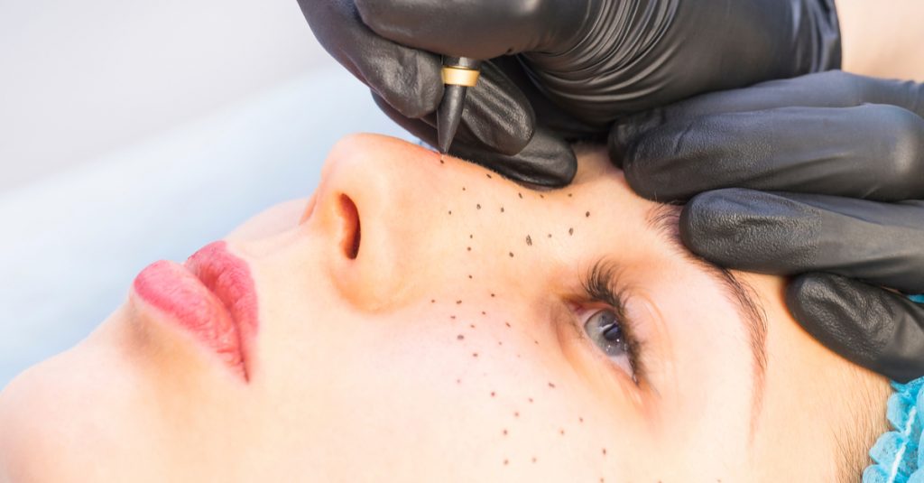 tatuaggio lentiggini