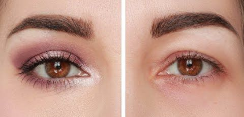 prima e dopo palpebra cadente