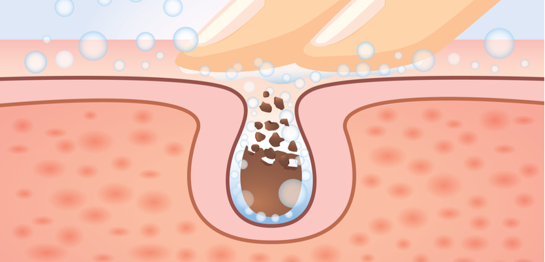 azione anti impurità acidi pelle