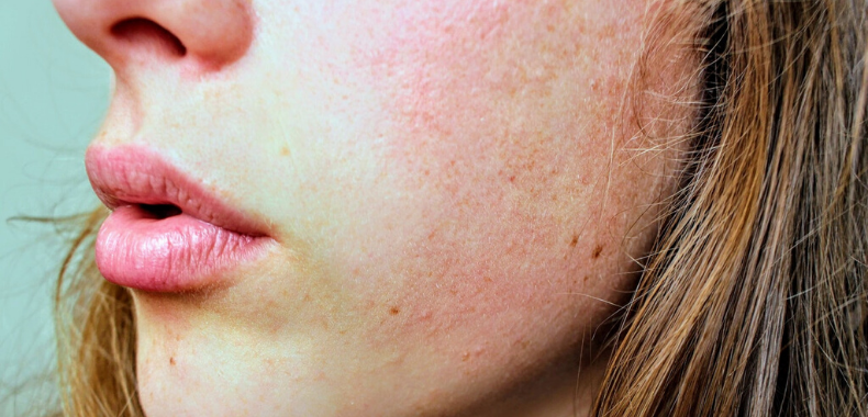 acido salicilico pelle