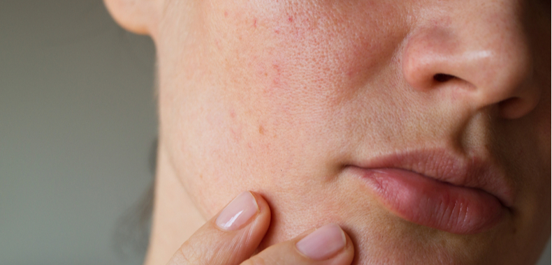 acido mandelico contro acne