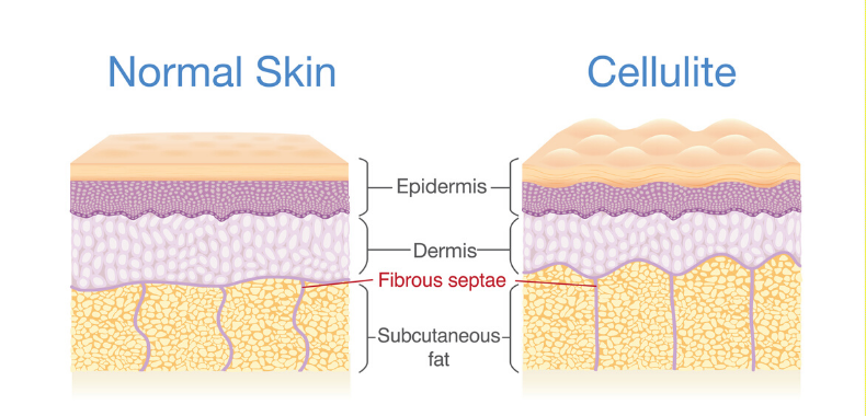 cause-cellulite