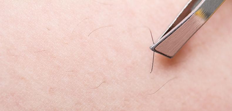 Come Eliminare I Peli Incarniti 5 Rimedi Naturali Per Dirgli Addio