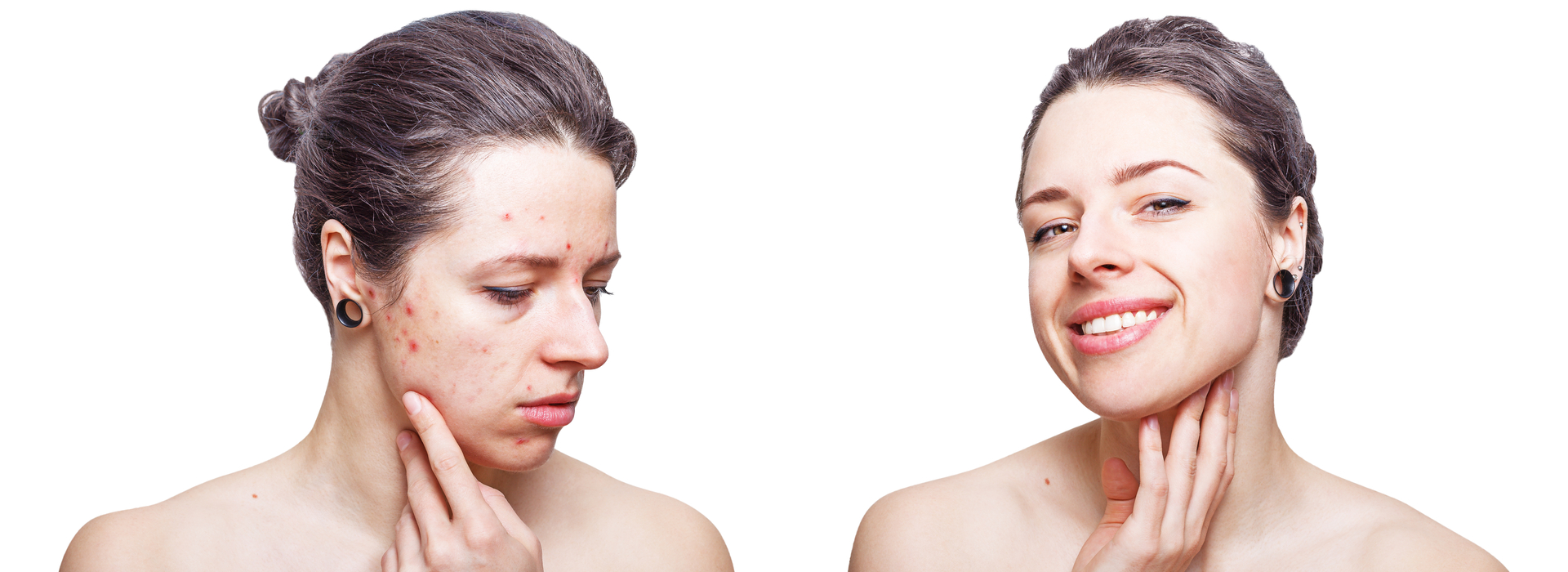 Skincare pelle acneica: consigli ed errori da evitare