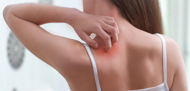 puntura di zanzara prurito