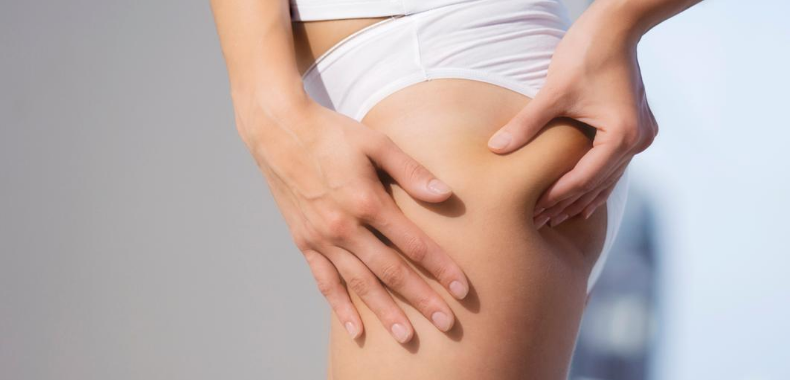 cellulite