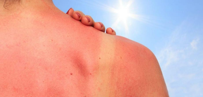 scottature-da-sole-rimedi-patate