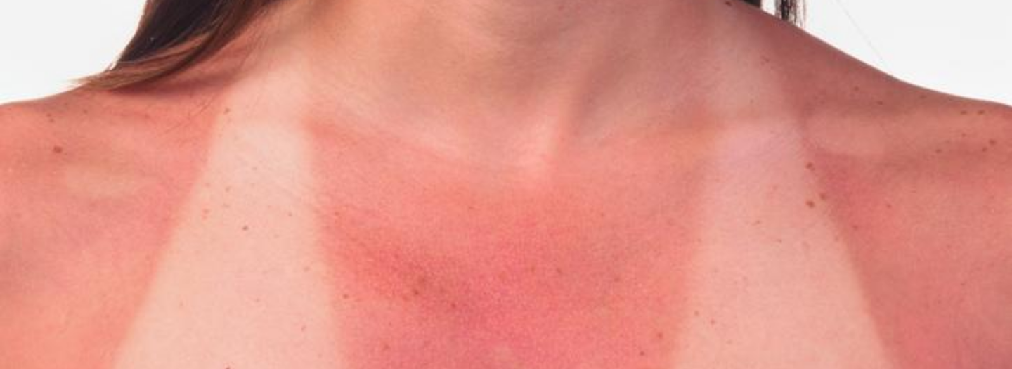 Pelle scottata dal sole? I rimedi naturali per non dire addio alla tintarella