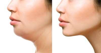 Come eliminare il doppio mento: esercizi e rimedi