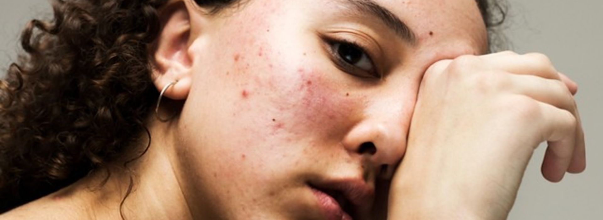 Beauty routine per la pelle impura: la skincare contro brufoli e imperfezioni