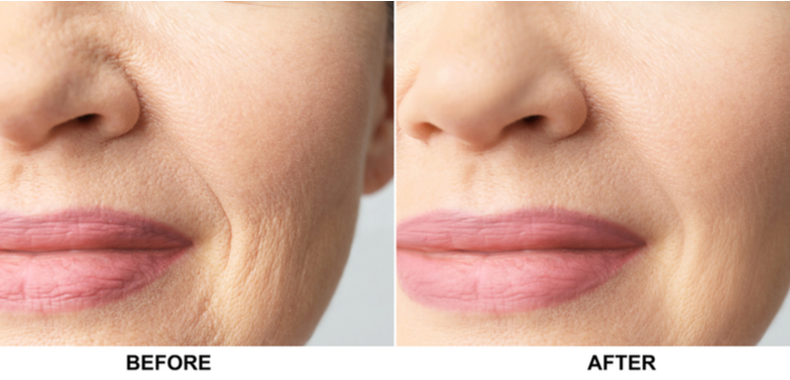 biorivitalizzazione prima dopo